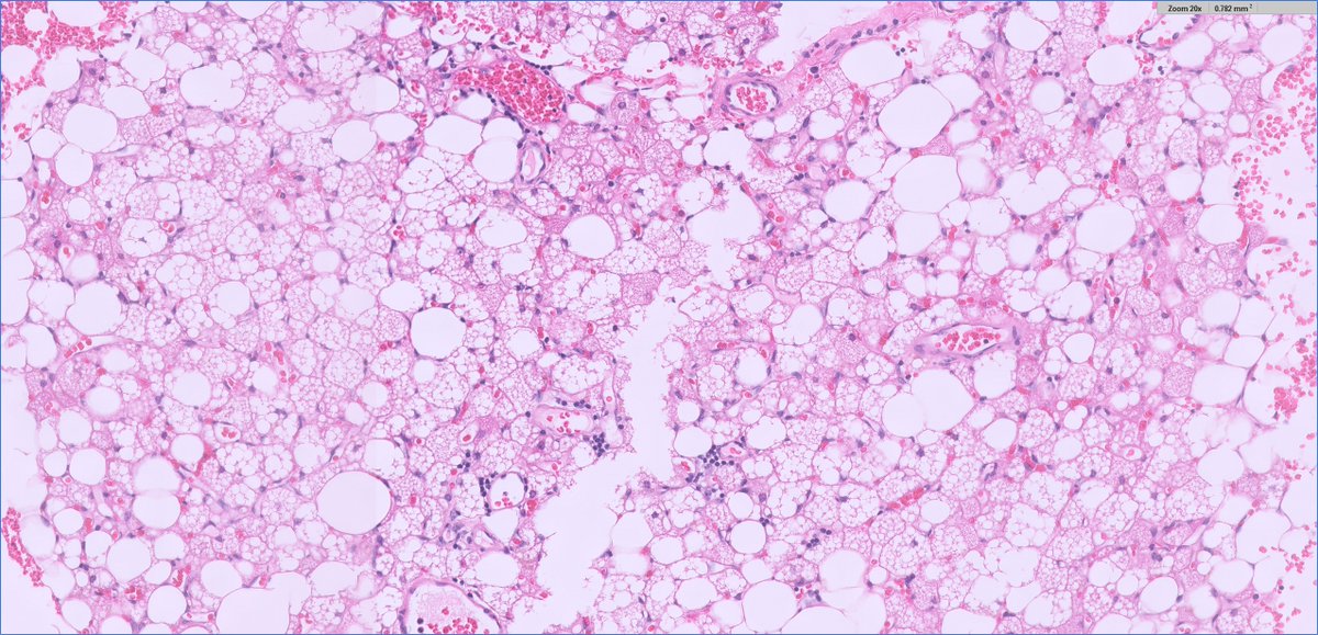 slusagar's tweet image. interesting #endopath/#GUpath adrenal🔬:

pheochromocytoma with brown fat in surrounding adipose tissue

@AMubeen_Path @DrCristinaMagi had a nice @TheUSCAP abstract on this topic a few years back