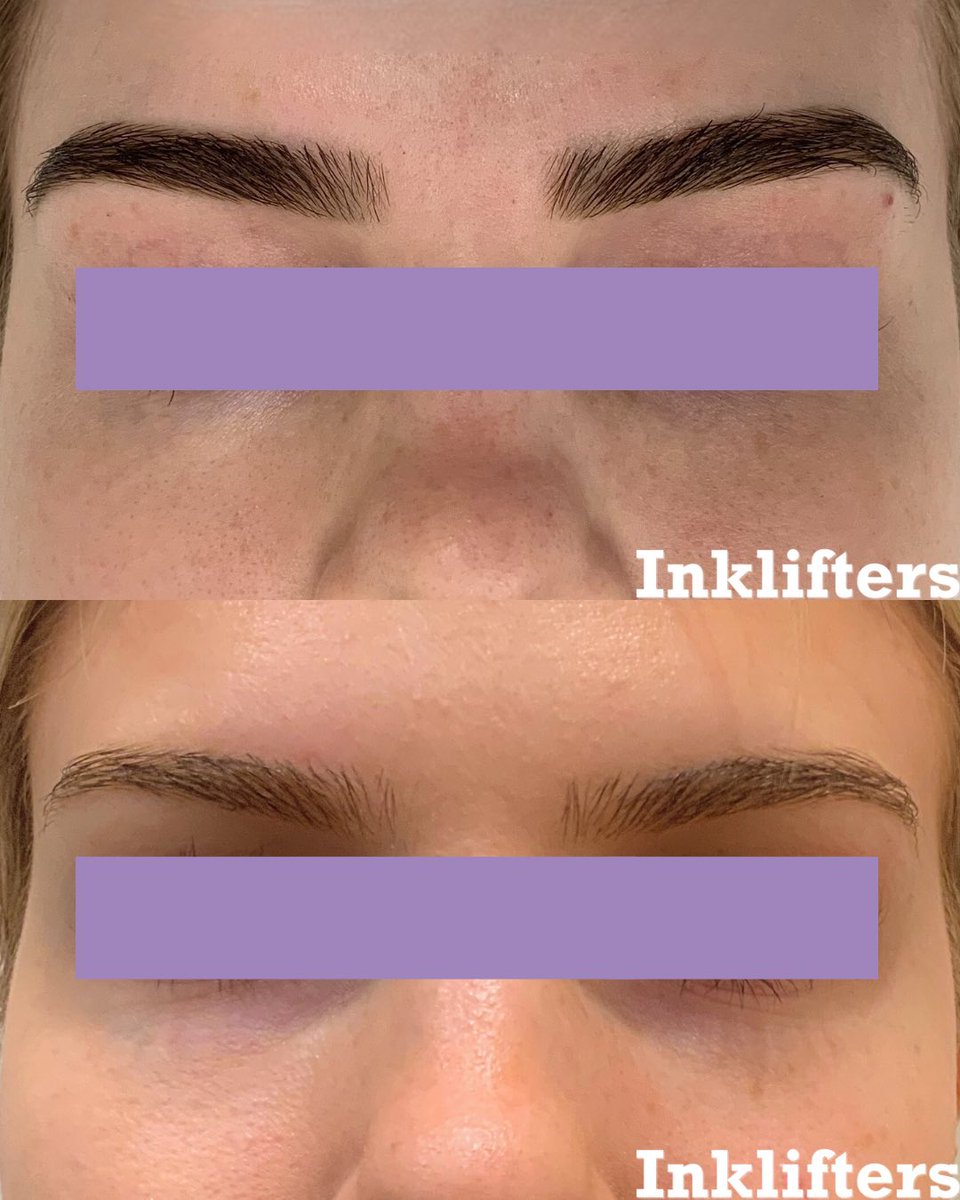 Eyebrows = reset to factory settings 😎👏

These before and afters show just two sessions of laser eyebrow tattoo removal, targeting unwanted microblading pigment safely and precisely.