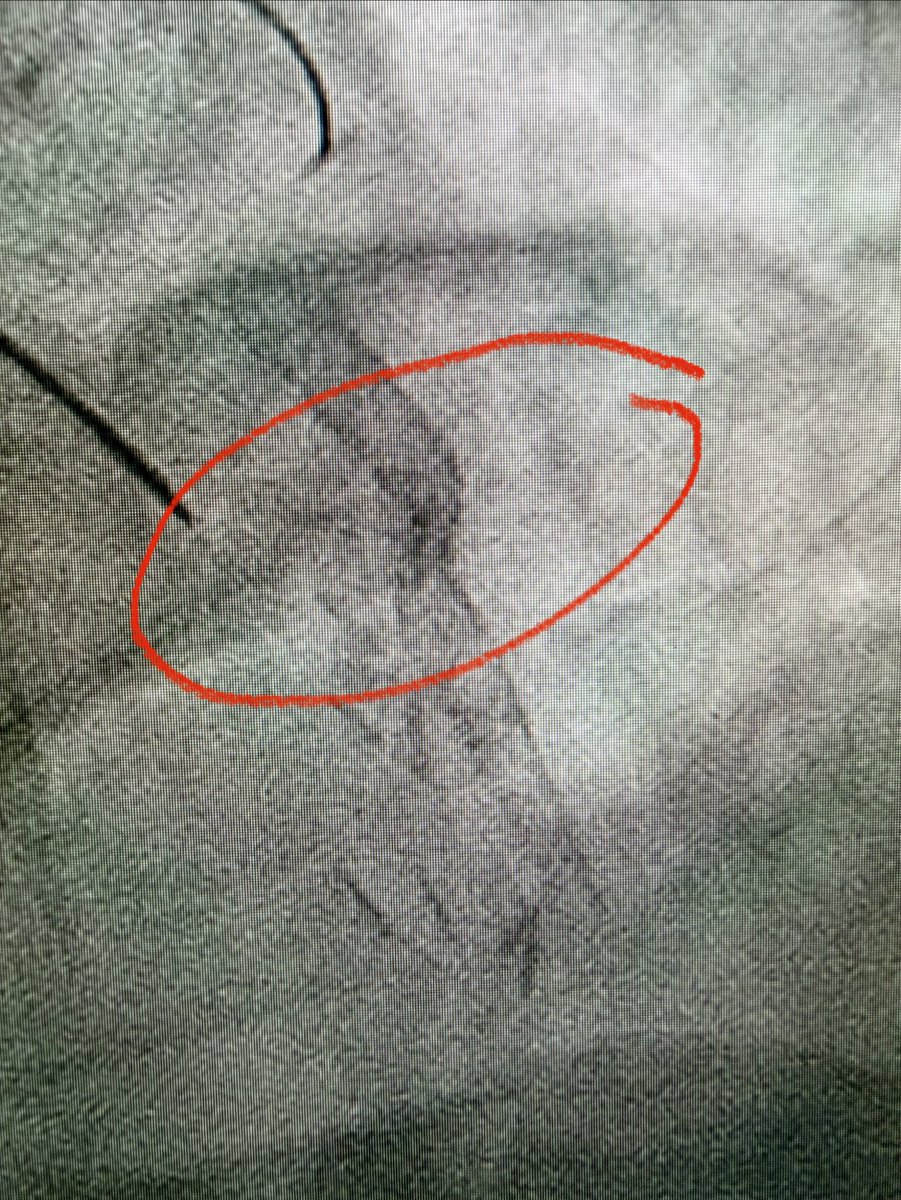 agtruesdell's tweet image. 1/2 Great #CTO case led by my partner @lindsey_cilia: ostial Diagonal CTO with occluded SVG-Diagonal and underexpanded prior SVG-Diagonal stent across the anastomosis and no retrograde options…