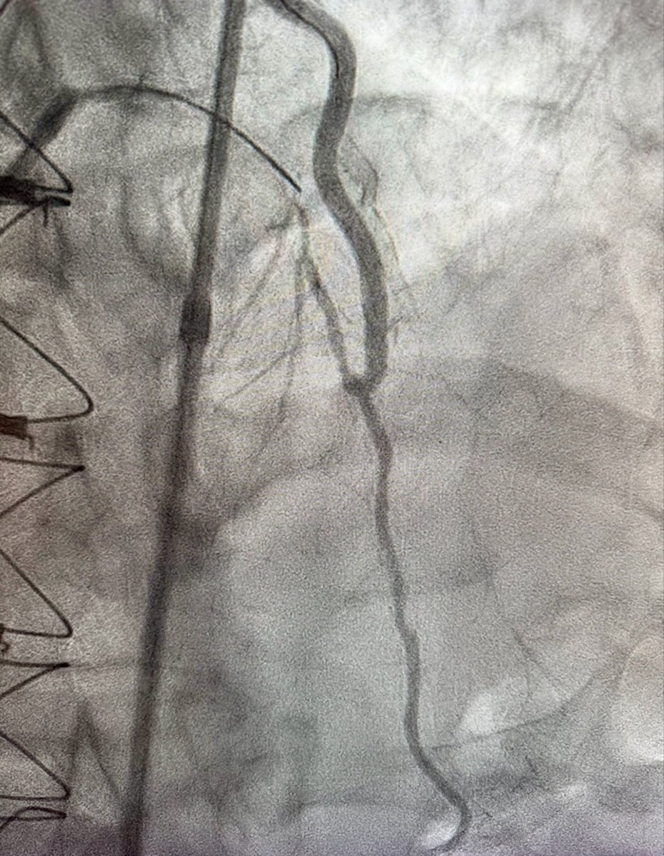 agtruesdell's tweet image. 1/2 Great #CTO case led by my partner @lindsey_cilia: ostial Diagonal CTO with occluded SVG-Diagonal and underexpanded prior SVG-Diagonal stent across the anastomosis and no retrograde options…