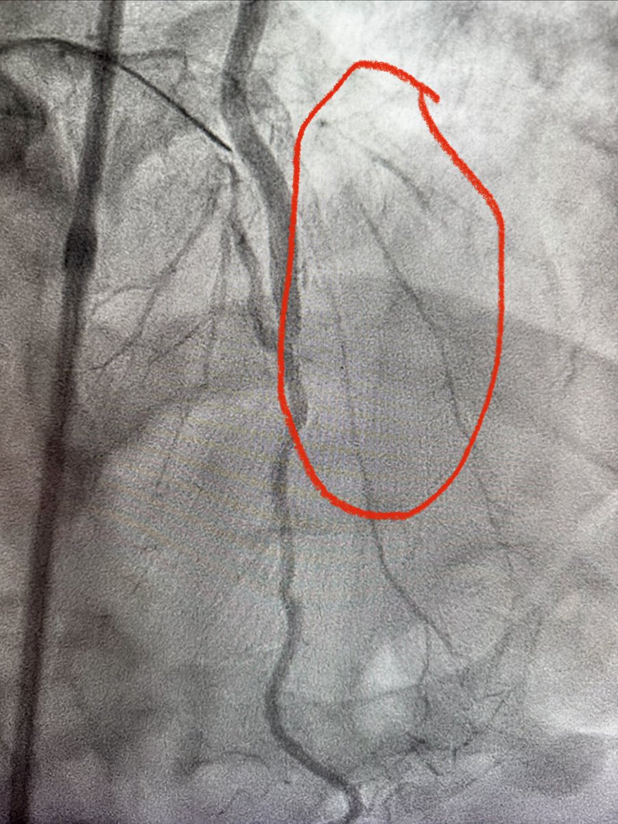 agtruesdell's tweet image. 1/2 Great #CTO case led by my partner @lindsey_cilia: ostial Diagonal CTO with occluded SVG-Diagonal and underexpanded prior SVG-Diagonal stent across the anastomosis and no retrograde options…