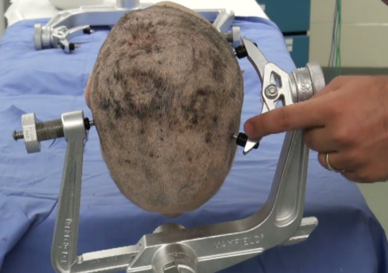 realQFS's tweet photo. Not discouraging you from donating your body to science. Sometimes when you body to science, it won't be on a slab, opened up for med students to see. It amy be cut up. This is a Mayfield clamp which holds a patients head during surgery. There's a head clamped in it, but no body. https://t.co/CpyCWPyS0m