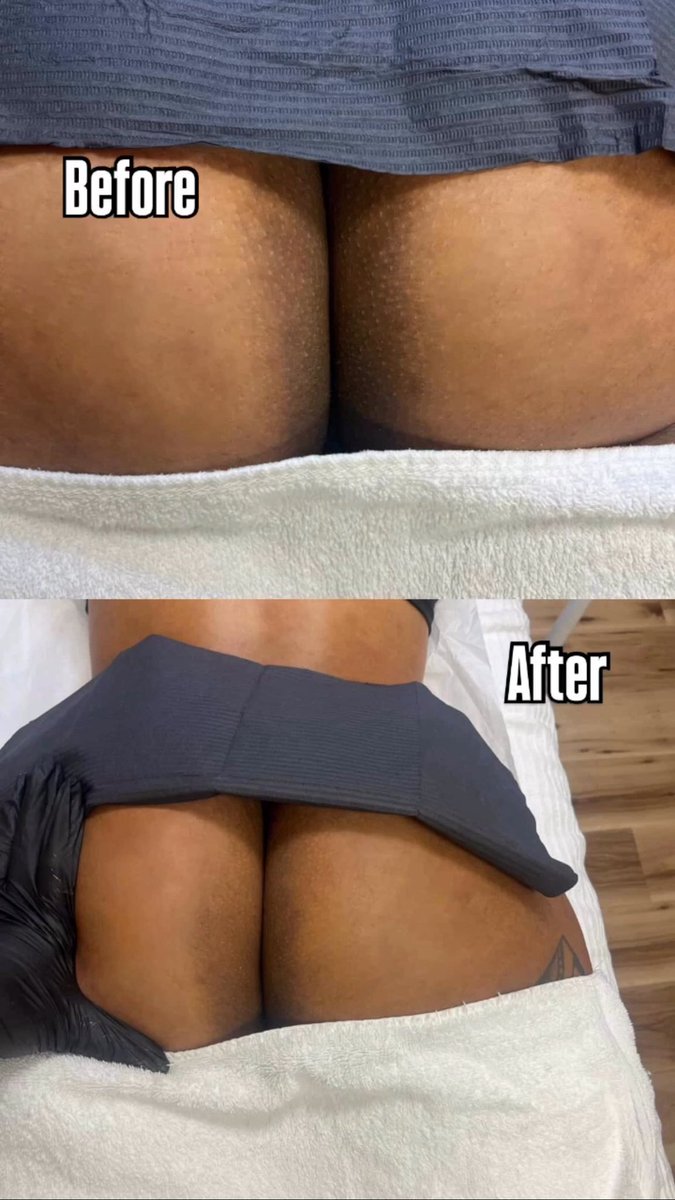 Get that booty bleached ….

Intimate Lightening results done at @Jbskin.loft located in Charlotte NC. Hit her up for all intimate bleaching services. 

Use my 50% off code: STROKE50 

IG - @JBskin.loft 
Website : jbskinloft.com