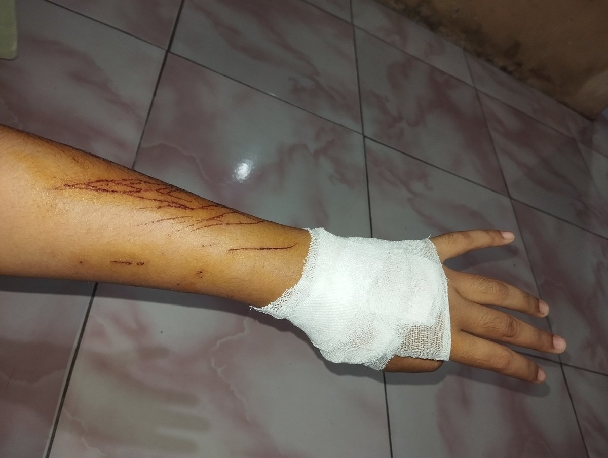 ceddart's tweet photo. @tanyarlfes guic..... yaallah ga ekskpek rame 😭

beneran ko itu di gigit kucing, yang di pergelangan tangan digigit sampe kena pembuluh darah juga btw... baru seminggu ini juga abis steril ko si adek... 😭 
kronologi kenapa bisa sampe aku dicakar itu karena diluar ada kucing jantan lain https://t.co/I7zQ9cRkEb
