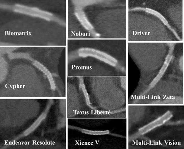 w_jyg's tweet photo. Wonder how’s difference #stent platform looks like under #CTCA https://t.co/e7iDjuTvsw