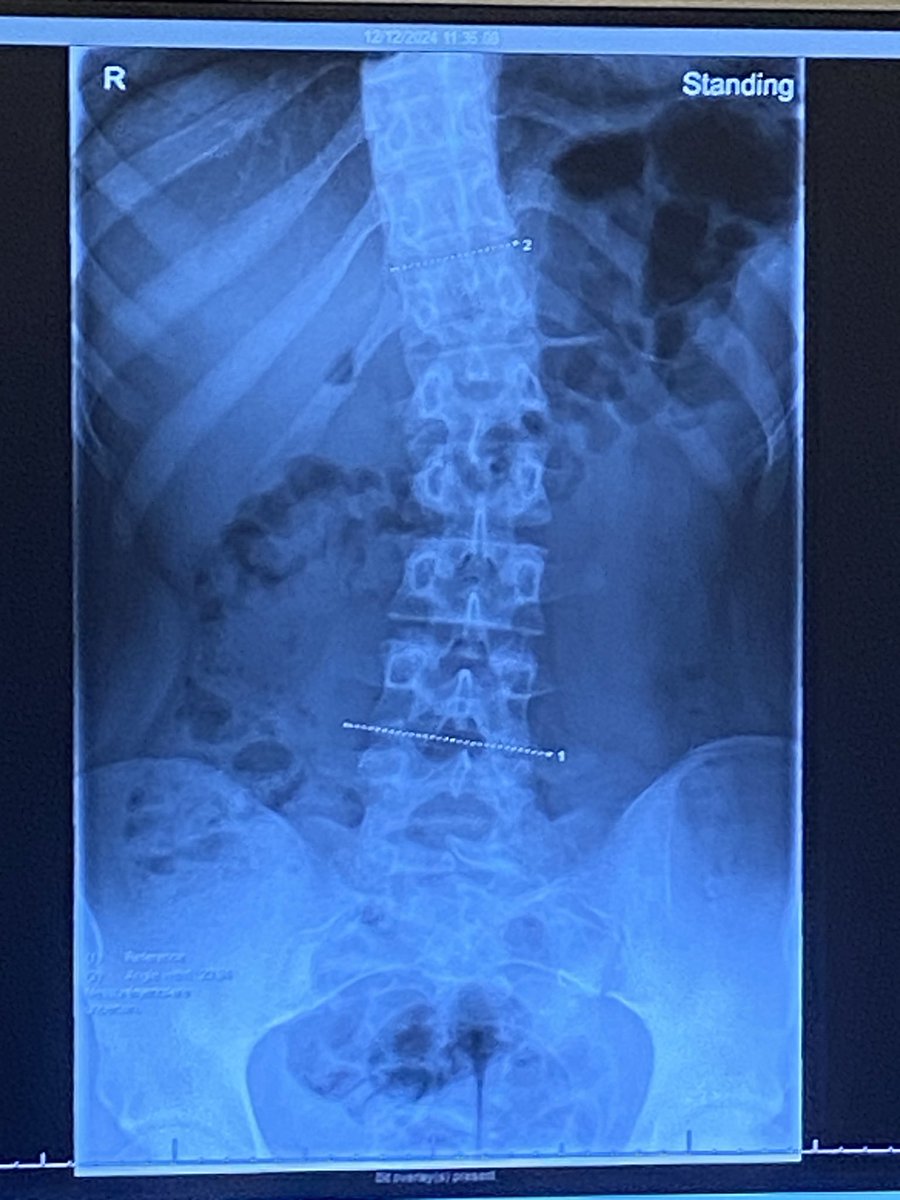 0O0OOO0O000's tweet photo. to be totally honest i wanna be skinny so so so bad but i’m scared to lose weight because i have scoliosis and i think i’ll look stupid… my ribs are turned so they’re visibly uneven.  #help #scoliosis #wtfdoido https://t.co/erAIiOkNGl