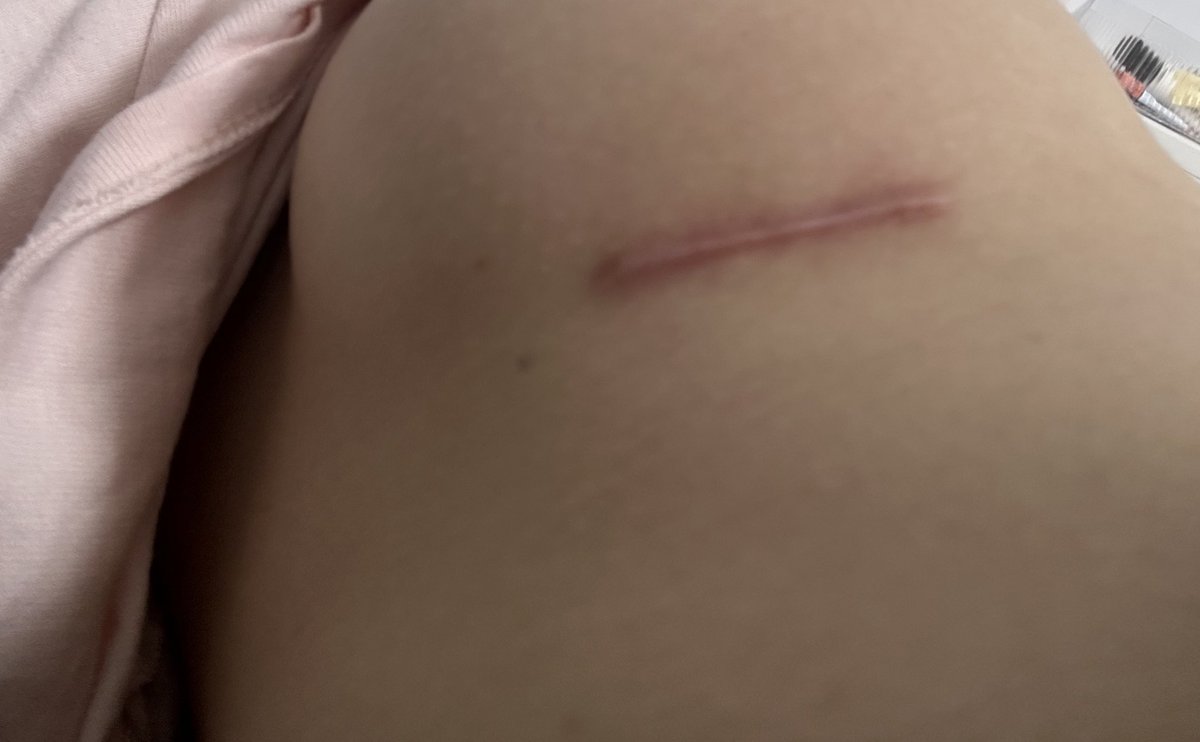 豊胸の傷跡目立つなあ
ケロイド体質やし仕方ないけど
これ治し方何があるんだろ…
塗り薬系はずっとやってるし、レーザーとか内服薬系でオススメあれば教えてください😢