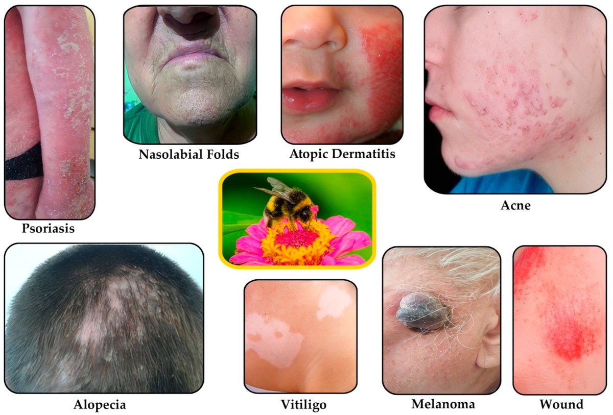 Cosmeticsmdpi's tweet image. #OpenAccess #Review
📑Title: A Journey Along the Boulevard of #Bioactive Compounds from Natural Sources, with #Cosmetic and #Pharmaceutical Potential: #Bee Venom, #Cobra Venom, #Ficus carica
Authors: Monica Dinu et al.
📌 brnw.ch/21wWr0A