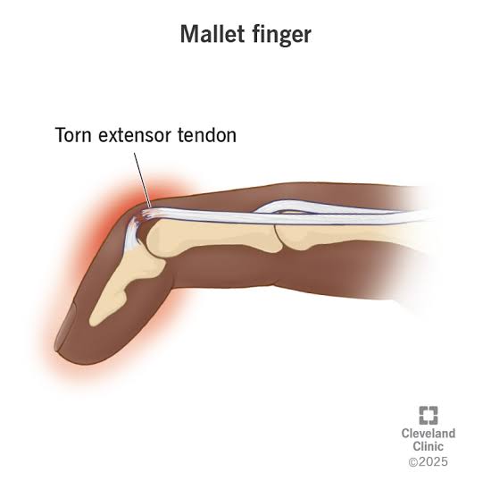 <a href="/nervemed/">nervemed</a> ✅Mallet finger = Extensor tendon rupture at DIP 🦴

Cause: Sudden forced flexion (ball injury 🎾)

🔬Clinical: Drooping fingertip, inability to actively extend DIP 👆

💊Rx: Continuous DIP extension splint 6–8 wks 🩹; surgery if large avulsion/volar subluxation