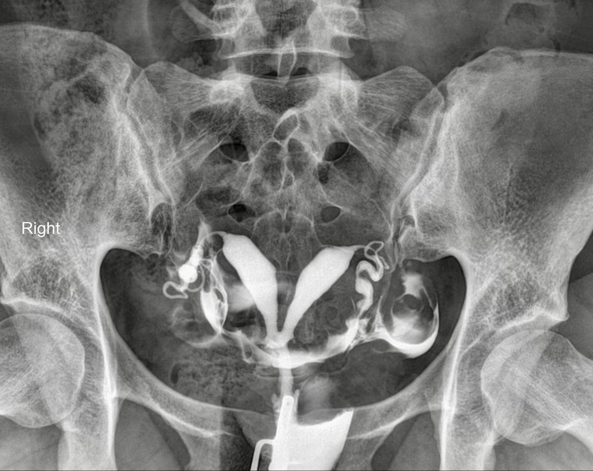 28-year-old woman with recurrent pregnancy loss

What’s this finding?