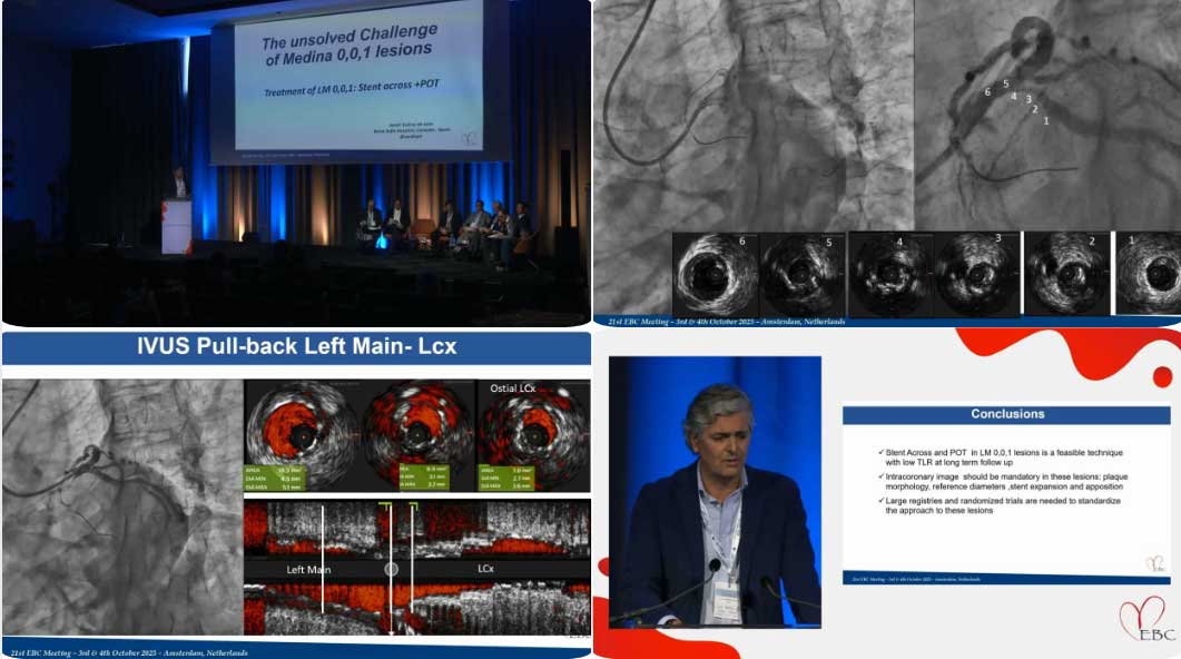 🫀EBC 2025 - SESSION 10 - The Unsolved Challenge of Medina 0.0.1 Lesions 
Intervención de <a href="/cardiojsl/">Javier Suarez d Lezo</a> en la conferencia anual de <a href="/BifurcationClub/">European Bifurcation Club</a> sobre lesiones de bifurcación coronaria.
#Cardiology #cardiotwitter 

❤️Apasionados por la #cardiologia
👉youtube.com/watch?v=SdlKa6…