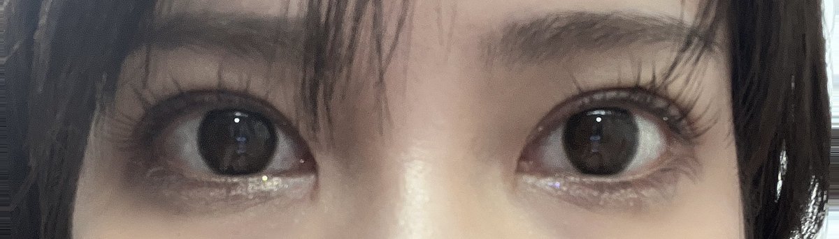 1118_3's tweet photo. 目整形してから1ヶ月経ちました！
自然癒着＋目つき矯正＋目頭切開
担当医はウィ・ソンジェ先生です😋

もうほとんどアザは消えて後は傷跡すこーし残ってるくらい🥺
もともと左右非対称の目やけど左右差整える事で顔の見え方も変わるし、何より化粧が楽しくなる🥰

迷うならやるべし🥰 https://t.co/7DJ8e34PZy
