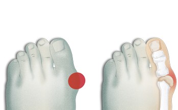 hospitalclinic's tweet image. Avui és el Dia Internacional de la #podologia. 👣

El #galindó és la deformitat més comuna de l’avantpeu i pot ser dolorós o no. Externament es pot apreciar l’aparició progressiva d’un bony al marge intern del dit gros del peu. 

➕info a #PortalCLÍNIC 👉 tinyurl.com/mry648p4