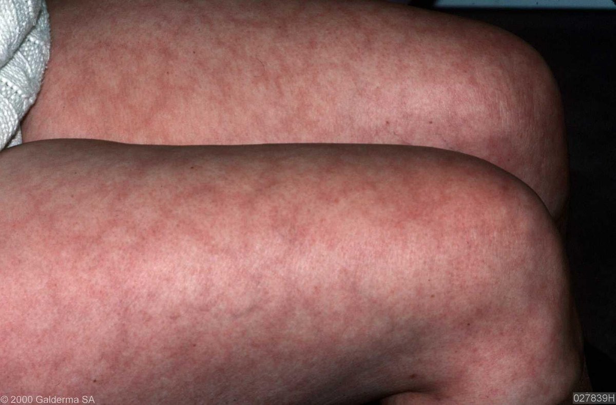 A lacy mottled red or purple pattern on white skin and dark or brownish coloured blotches on dark skin. most commonly found on the legs, arms and trunk but can also affect the face, hands, feet &amp; buttocks. Caused by an interruption of blood flow to the small blood vessels. #lupus