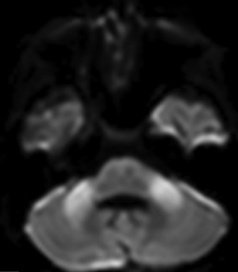 🧠 #SPINTweetorialWednesday
Fulminant SSPE (fSSPE)—the rare, rapidly downhill variant of post-measles encephalitis where DWI restriction can be your earliest imaging tell. Let’s go!
Primary deep dive: Prasad et al., Neurol India 2022 → doi:10.4103/0028-3886.338737.