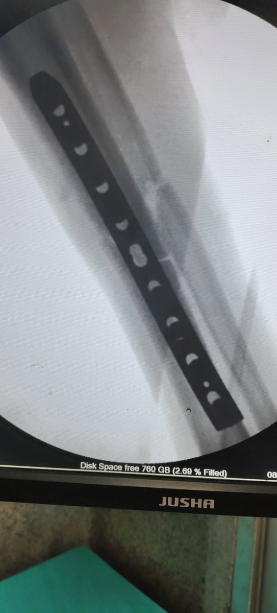 Dr_KD_MS's tweet image. This 14 year old child has malunited tibia (55 Days Old) ORIF with LCDCP plate done today at #PMCH 
#Bihar