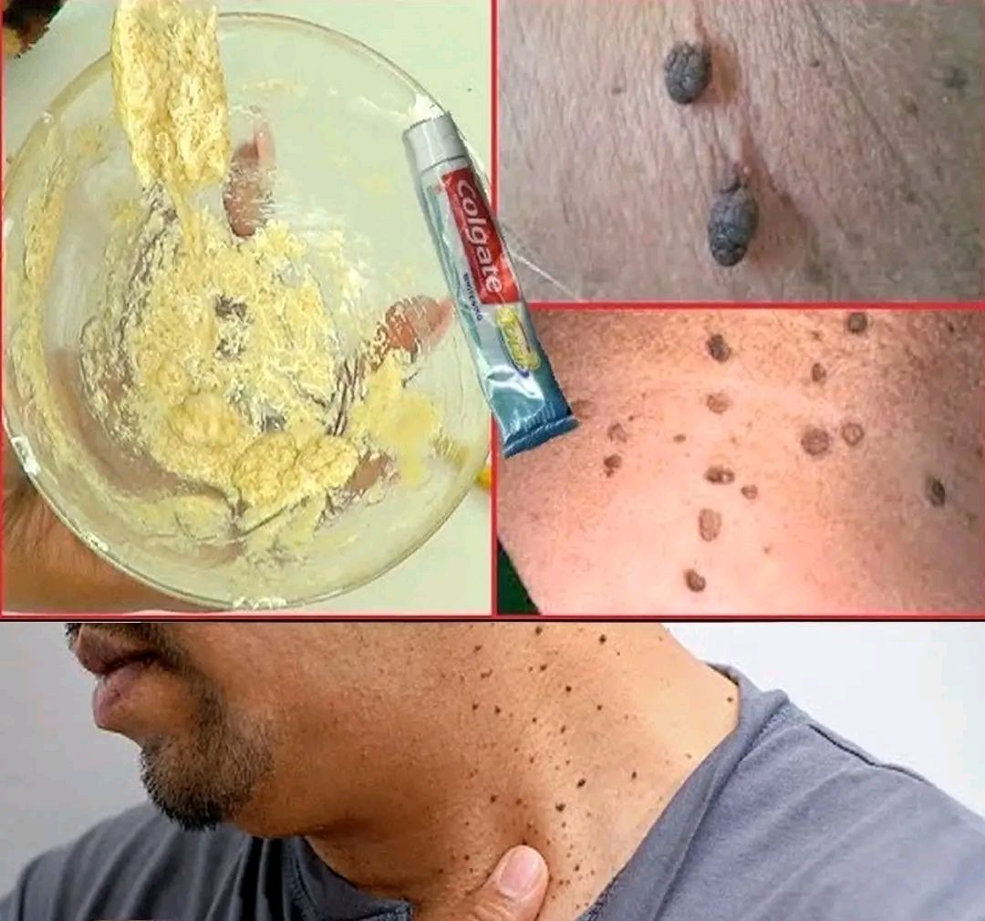 Herbalisque's tweet image. 🧄🍎 Overnight Garlic Remedy for Warts &amp;amp; Skin Tags!

Mix 1 tbsp apple cider vinegar + 1 tbsp baking soda + 3–4 drops tea tree oil into a thick paste.
Apply to the wart or skin tag, cover with a cotton ball and tape, and leave overnight.

✅ Shrinks and dries warts or tags…