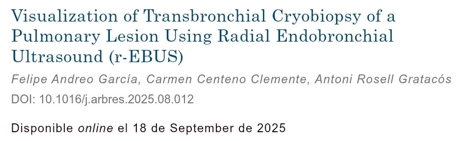 juanjocruzrueda's tweet photo. Muy agradecidos por la cita en la nueva publicación en AB.

Nos complace ver que el método modificado que describimos y aplicamos previamente sigue generando interés y contribuye a la creciente evidencia en broncoscopia

📄 Nuestro artículo completo aquí: https://t.co/uLJSCi86GS https://t.co/C5ypHC1hu3