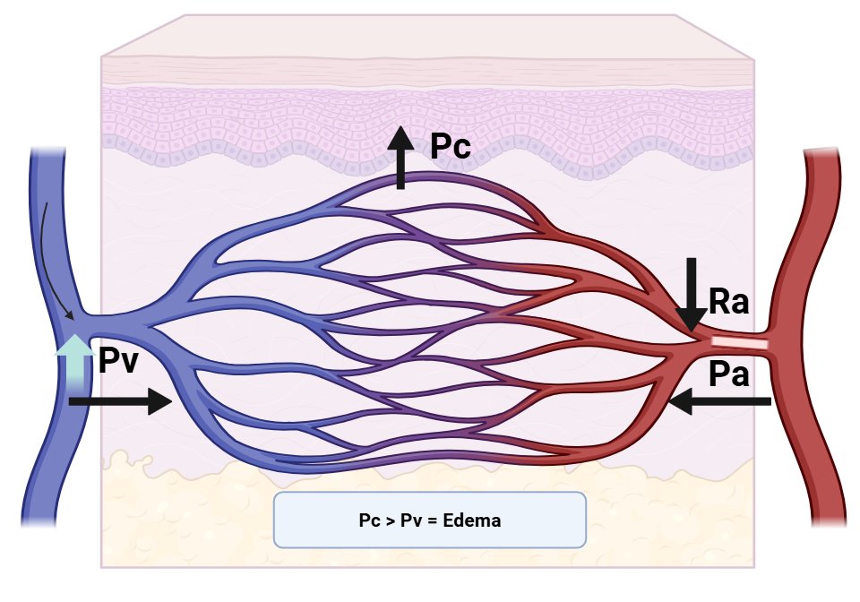 intensivaev's tweet image. 1/ After the excellent discussion a few days ago by the incredibles @NephroP @icmteaching @khaycock2 @ArgaizR , I made my humble contribution by creating these illustrative figures.
Among several factors — such as lymphatic clearance efficiency, albumin , and skin compliance —…