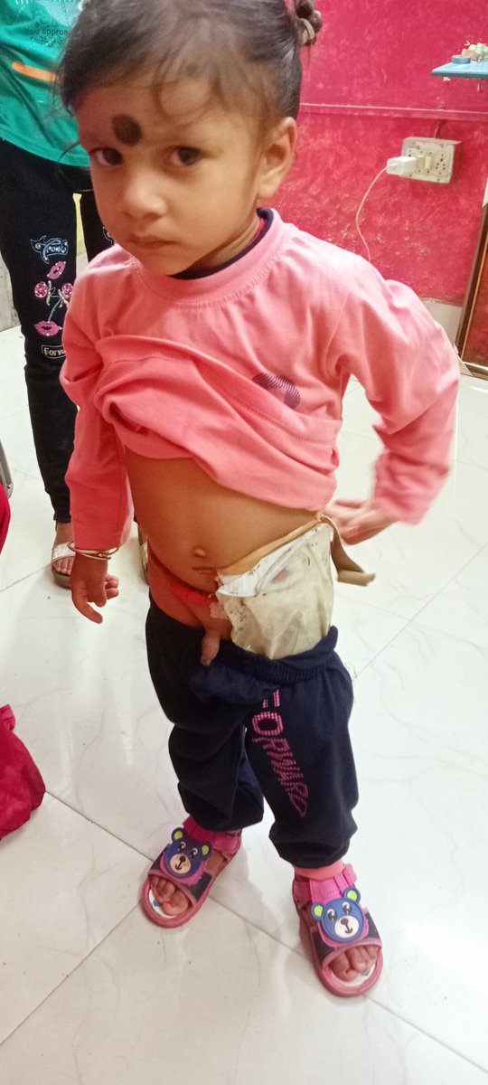 Karande56621558's tweet image. मुख्यमंत्री .@HemantSorenJMM जी, पूर्वी सिंहभूम जिले का 3 साल के मासूम की किडनी खराब है, परिजन इलाज कराने में असमर्थ हैं। बच्चे को गंभीर समस्या है, पेशाब बगल की थैली से हो रहा है। कृपया मदद करें! #HelpUs #CMHelp #SaveChildLife

.@IrfanAnsariMLA जी 
.@deepakbiruajmm जी 🙏