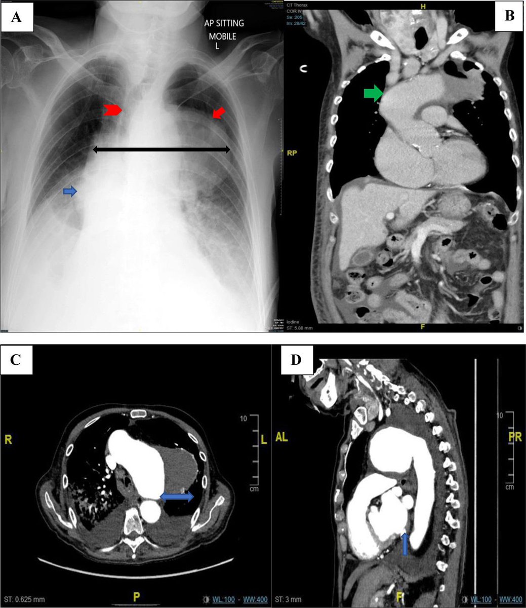 📷 Así se llama la nueva imagen científica: Aortitis sifilítica: un imitador de masa mediastínica. Descubre sobre este fenómeno en #ArchivosdeBronconeumología

🔗 Accede aquí: n9.cl/kjhzb

#SEPAR