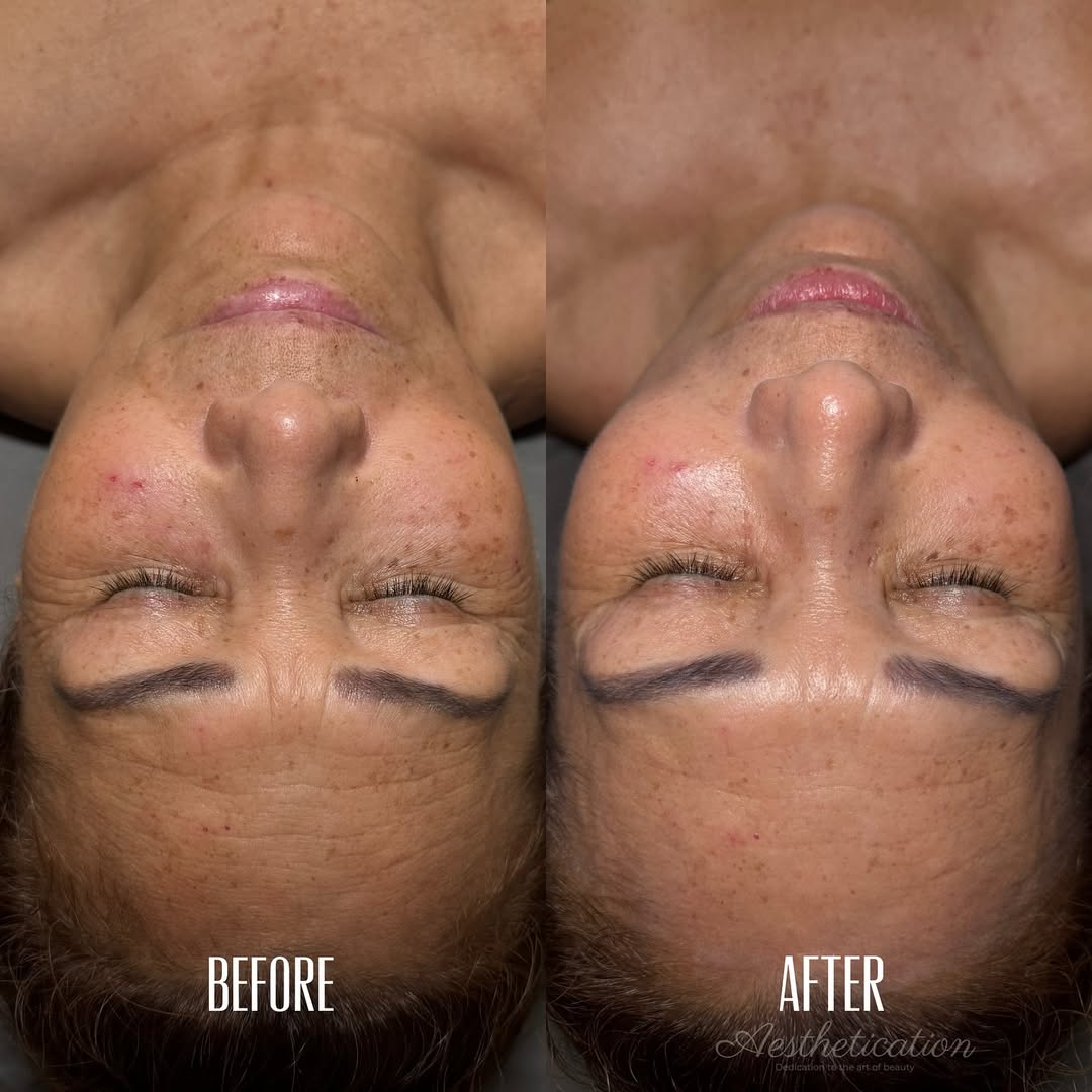 Talk about multitasking 👏 A gorgeous wrinkle transformation from <a href="/aesthetication/">aesthetics</a>.cb — all while getting pain relief on her broken foot with our Pain Light.