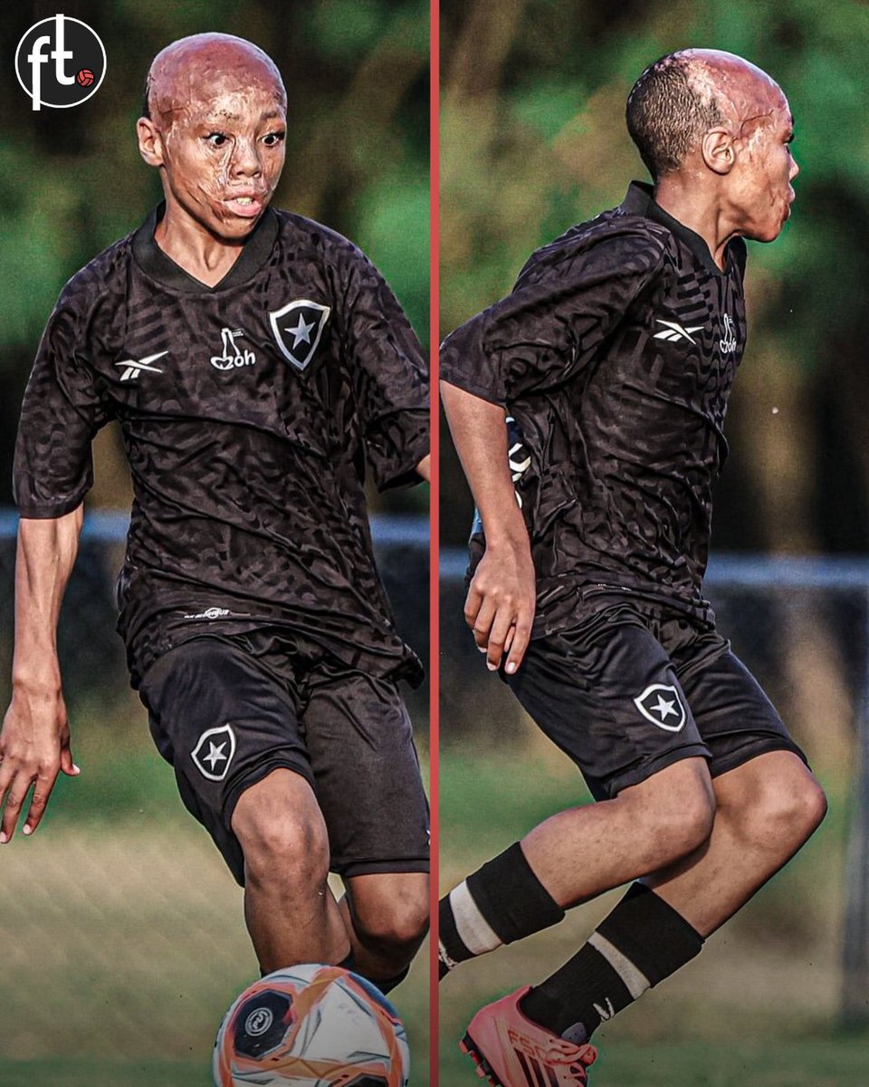 Football__Tweet's tweet image. Meet Bernardo Lopes, the latest recruit at Botafogo's academy. 🇧🇷
At the age of one, he was the victim of a terrible accident: a pot of boiling water fell on his face. By a miracle, he survived against all odds after spending seven months in the hospital. 🙌
Despite this…