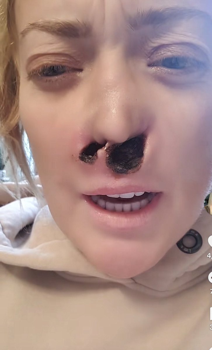 axhleighlouise's tweet photo. A woman on TikTok went to Turkey for dental implants. The dentist drilled too deep, puncturing her sinus. She developed nasal sores that turned into a flesh-eating infection. After months of being denied treatment, her nose has now completely collapsed. https://t.co/Pp2OhUBDVt