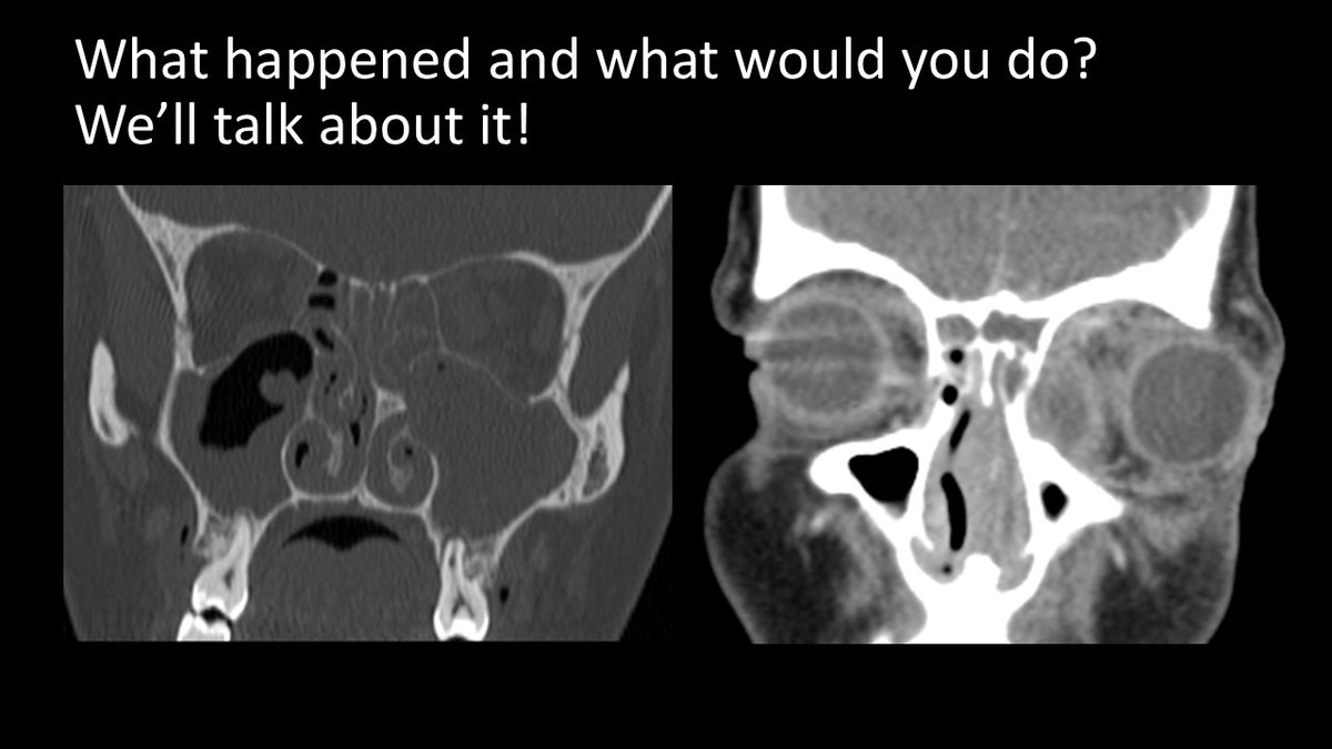 If anyone is in #Indianapolis for next week’s #OTOMTG25 meeting, I’m speaking Oct 14 10-1050 on #ODS. Making a NEW talk for this. Delving DEEP into why 🦷 and 👃 matter, with 2/3 being CASES from Dx to Rx. <a href="/henryfordent/">Henry Ford ENT</a> <a href="/ent_ams/">Alberto Maria Saibene, MD, MA</a> <a href="/MartaKwiat_ska/">Marta Kwiatkowska, MD, PhD</a> <a href="/DrScottFortune/">Dr. Scott Fortune</a> <a href="/N_ChapurinMD/">Nikita Chapurin, MD</a>