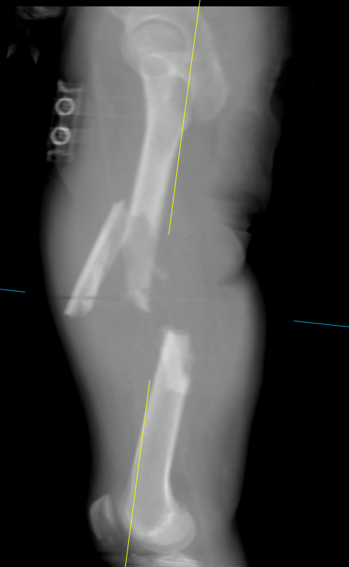 traumaticum's tweet image. Youve got a dude who rocks up with a leg like this

How are you assesing length and rotation in order to determine your reduction?

No exam answers - be practical. how do you actually sit down and figure out in what position this chaps leg gets screwed solid?

#orthotwitter