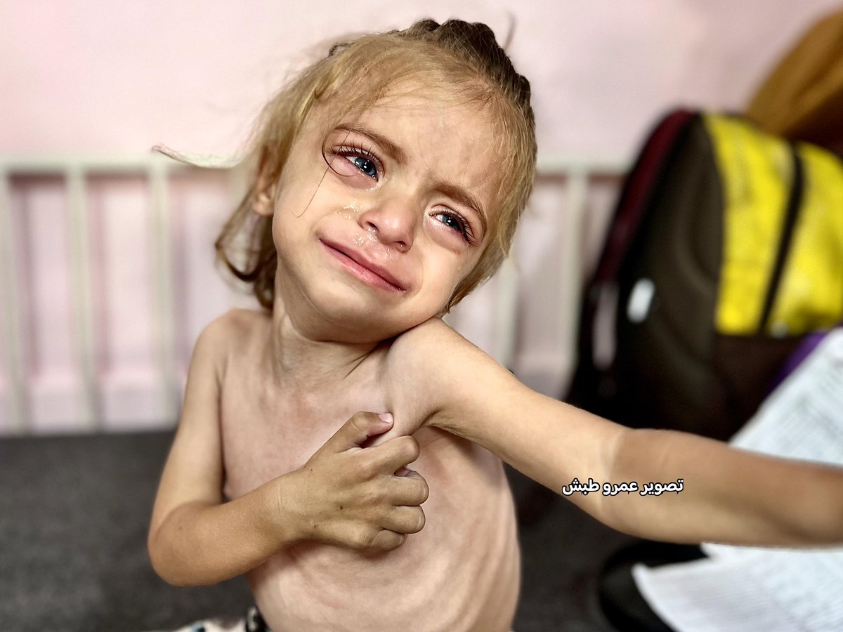 Two-year-old Celine Wadi, once a bright blue-eyed girl, now suffers from life-threatening malnutrition due to Israel’s blockade. Her frail body lies in Nasser Hospital, waiting for urgent treatment before it’s too late.