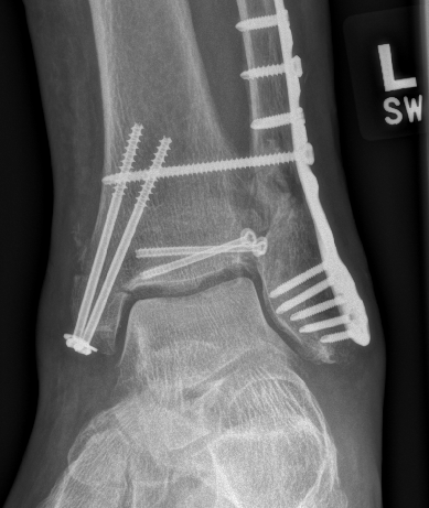 traumaticum's tweet photo. I always cringe a little when i see medial malleolar fixation like this

longer does not equal better! in fact, the longer the screw, the more likely youre in the medullary canal and there's literally NO BONE there!

most dense bone is at the physeal scar

https://t.co/1PAF9IXqj5 https://t.co/lnoAxrTtZm