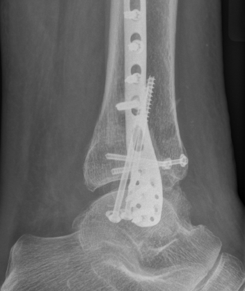 traumaticum's tweet photo. I always cringe a little when i see medial malleolar fixation like this

longer does not equal better! in fact, the longer the screw, the more likely youre in the medullary canal and there's literally NO BONE there!

most dense bone is at the physeal scar

https://t.co/1PAF9IXqj5 https://t.co/lnoAxrTtZm