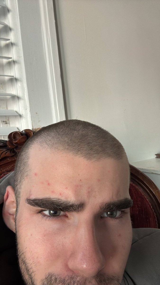 friendlygayguy's tweet photo. Pimples and I’m bald fuck my life bro https://t.co/gH5mXno6JN