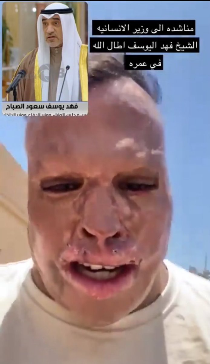 ajlalajl's tweet image. #وزارة_الداخلية 
#فهد_اليوسف_الصباح 
#مشعل_الأحمد_الجابر_الصباح 
#البدون 
#عديمي_الجنسية_في_الكويت 
دوله شرامطه مقحبه شنو هذا مافي رقابه دولية بس ابشرك فلوس مشعل في بنما مع السلامه الي بسم بناته