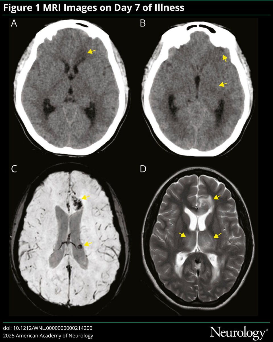 This #NeuroImage case highlights acute hemorrhagic necrotizing encephalitis as the initial radiologic manifestation of CNS tuberculosis: hubs.ly/Q03Mr25Z0