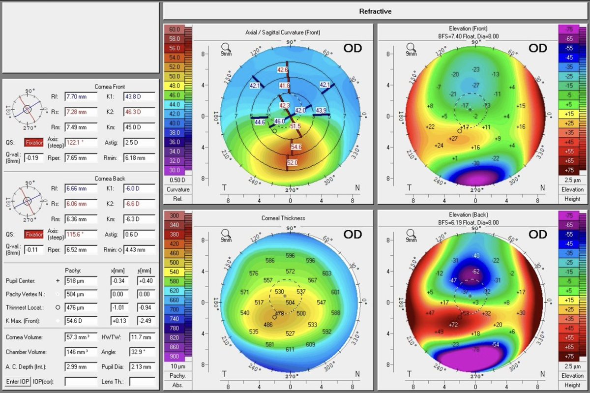 revoptom's tweet image. Researchers Decry a “Lack of Unified Criteria” When Defining Keratoconus Progression

Many studies analyze distinctly different parameters; the most universally accepted were Kmax, pachymetry and refraction.
reviewofoptometry.com/article/resear…
#keratoconus #cornea #eyecare #optometry