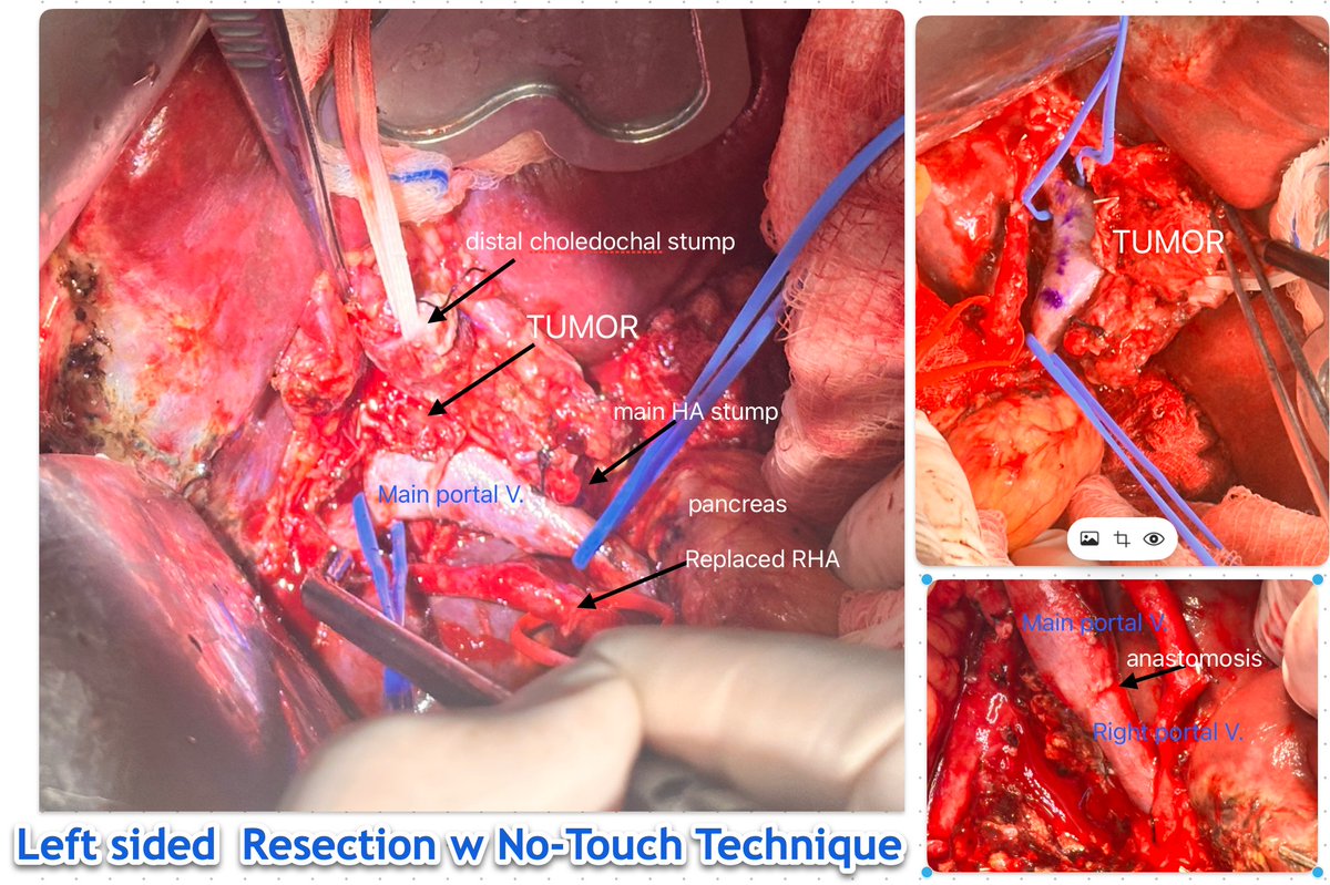 “No-touch” hilar dissection&amp;resection in Klatskin Tumor:
Neuhaus (Ann Surg 2012) → better 5-yr survival (58 % vs 29 %).
Nagino &amp; Clavien (2021) → not always feasible.
But remember—radial margin is the silent prognostic enemy. Protect it when possible, here is one case from us