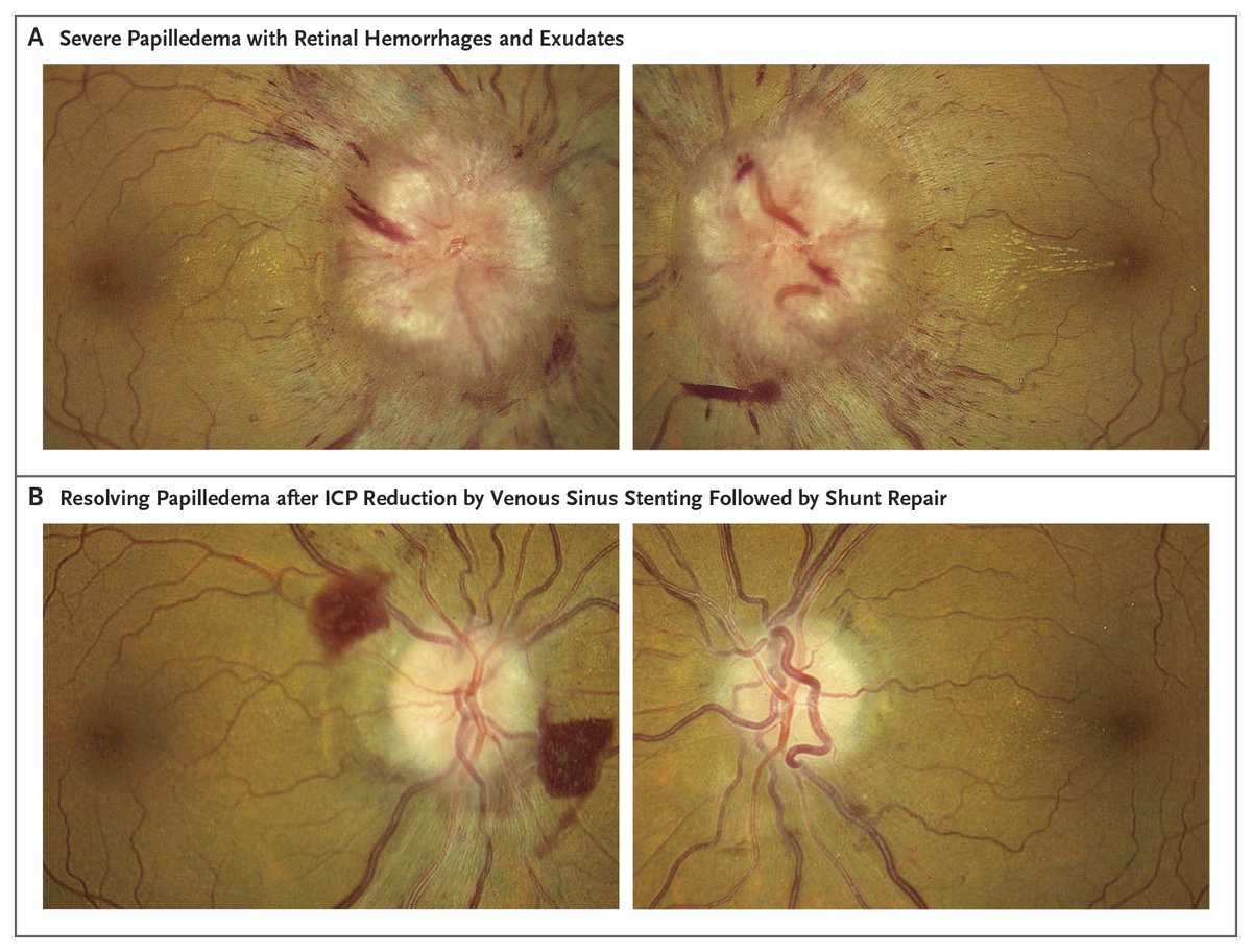 NEJM's tweet photo. Idiopathic intracranial hypertension — high cerebrospinal fluid pressure most common in women of reproductive age with obesity — threatens vision. Treatment includes weight loss, medication, and surgery.  

Learn more in the Review Article “Idiopathic Intracranial Hypertension” by Jonathan C. Horton, MD, PhD, from @ucsf: https://t.co/alUs13kzt3