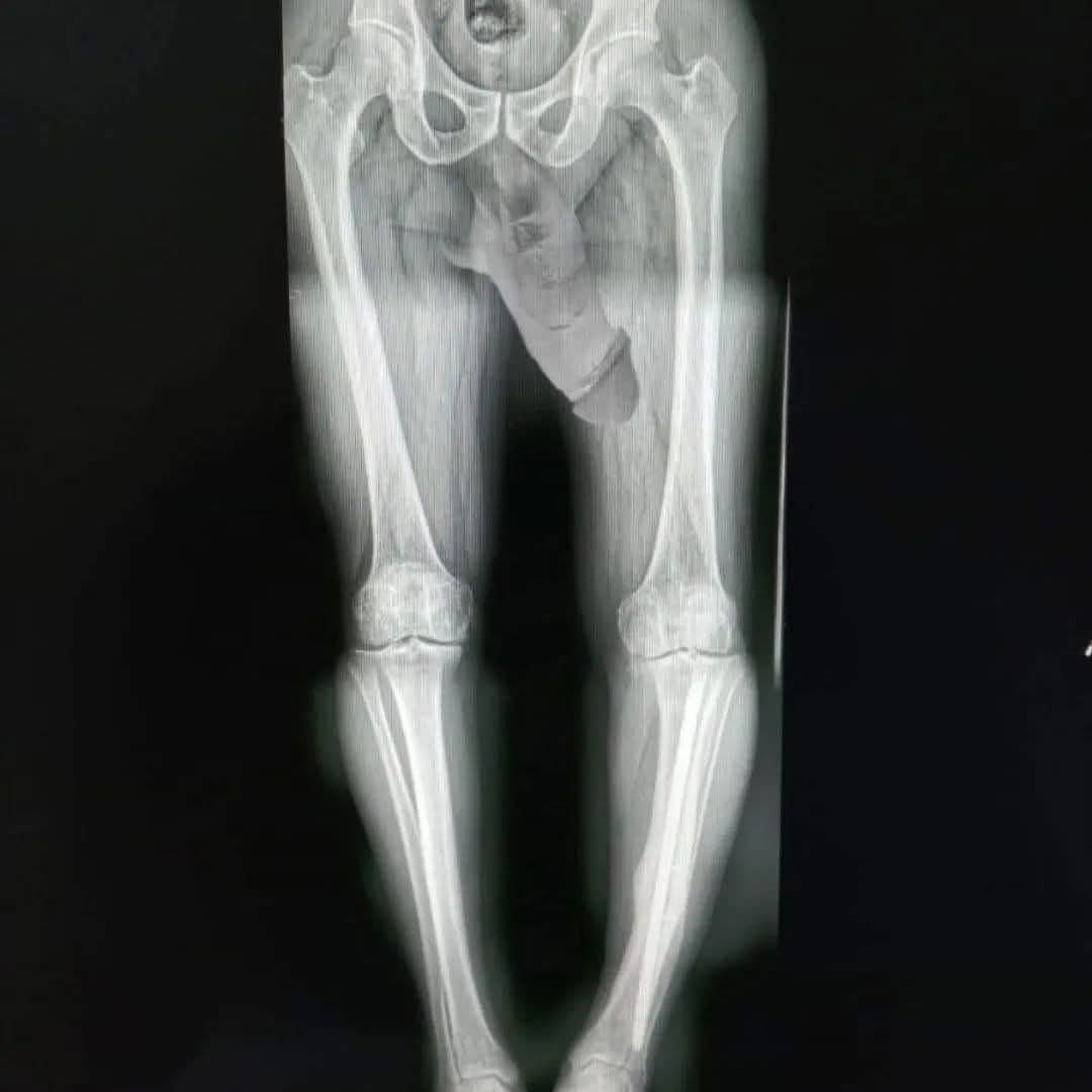 Gracias a los que se preocuparon por mi rodilla, como pueden ver, ya esta bien y todos los huesos en su lugar.