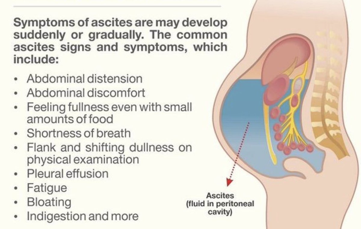 USMLEStepStudy's tweet image. Cirrhosis --&amp;gt; liver architectural distortion --&amp;gt; increased  intra-hepatic vascular resistance --&amp;gt; portal hypertension (elevated portal pressure) --&amp;gt; drives fluid from hepatic sinusoids thru surface capsule --&amp;gt; into peritoneal cavity --&amp;gt; overwhelming lymphatic drainage --&amp;gt; ascites