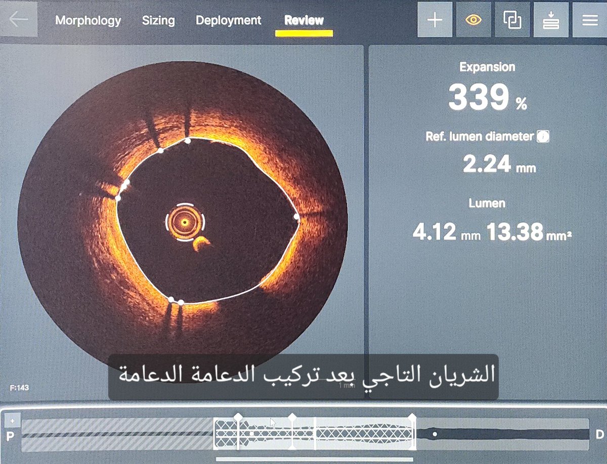 الالتزام بأدوية خفض الكوليسترول #ستاتين يقلل من الذبحات الصدرية وتصلب الشرايين التاجية.
#صحة_القلب
#القسطرة_التداخلية
#التصوير_الوعائي