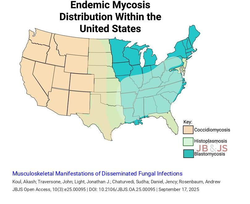 jbjs's tweet image. "Musculoskeletal Manifestations of Disseminated Fungal Infections" by Koul et al.
Tap the link to read the full article bit.ly/46QIyWd
#infection #JBJSOpenAccess