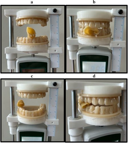 How much force does it really take to chew after jaw surgery? 🦷 We measured real bite forces + ran simulations to reveal what’s safest to eat post-mandibular reconstruction. Chew smarter, heal faster.
🔗 buff.ly/RQOG9AK
#JawSurgery #Recovery #IDDSI #OralHealth