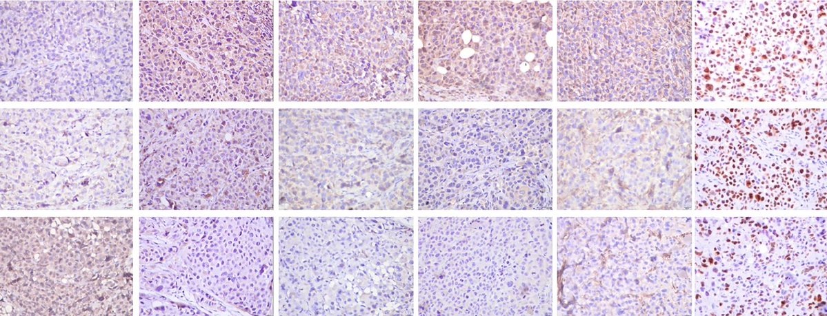 Intestinal_Cell's tweet image. 🦠 Helicobacter pylori-induced aberrant methylation of ID4 mediated by DNMT3B drives #GastricCancer progression via DEC1-SHH signaling pathway, reported Shandong First Medical University scientists and their team.
go.nature.com/46ZY2qQ