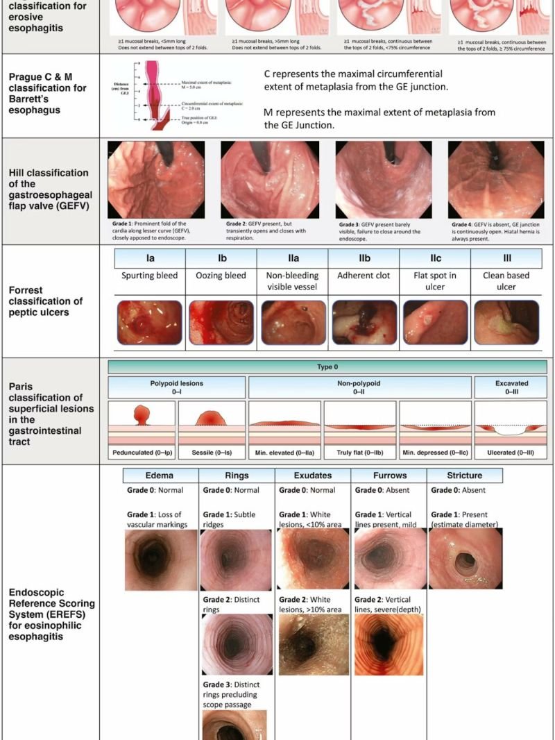 EndoCollabcom's tweet photo. Classification Systems for GI Endoscopy https://t.co/CPOp5YCJF9