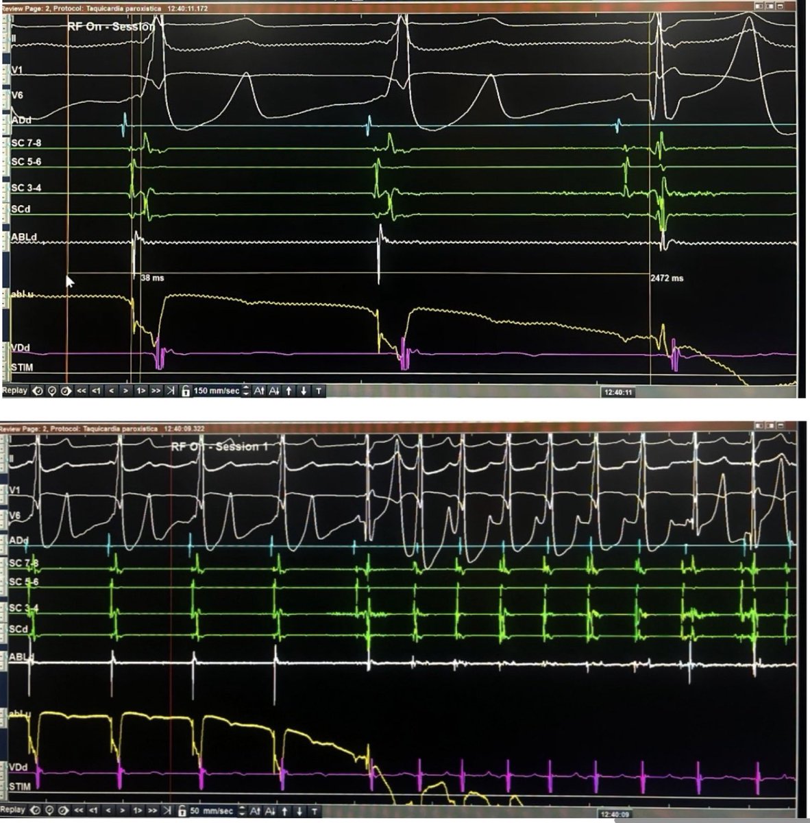 ALFIEEP1's tweet image. Parahisian #WPW RFA.
Success at 1st session. This location location is thought to be risky. However, RFA aiming the ventricular insertion is protected by the central fibrous body and AVB is very unlikely.
See always unipolar signal.
Kent automaticity= successful RFA