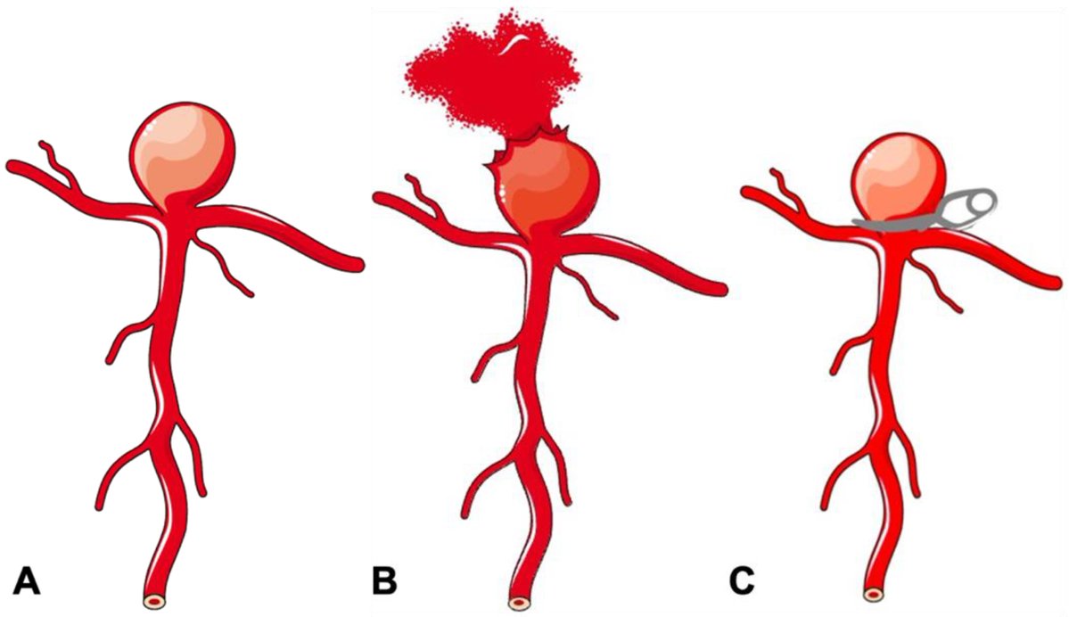 neurolint_mdpi's tweet image. Rupture of an intracranial aneurysm is a catastrophic event. Without access to treatment, the fatality rate is 50% in the first 30 days.
Read full-text at: mdpi.com/2035-8377/16/1…
#intracranial #aneurysm #endovascular #IA
