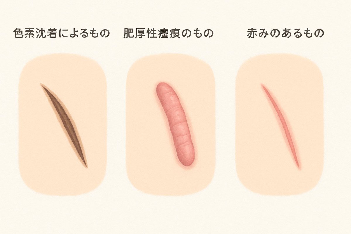 【お傷の痕について】
外科的な施術をする場合、お傷ができる事がほとんどですが、術後なかなか治らない💦
そんな方は以下の3つに分かれます🙇‍♂️
①色素沈着
②肥厚性瘢痕・ケロイド
③毛細血管の拡張や皮膚が薄い事による赤み

👉それぞれに対する治療はこちら