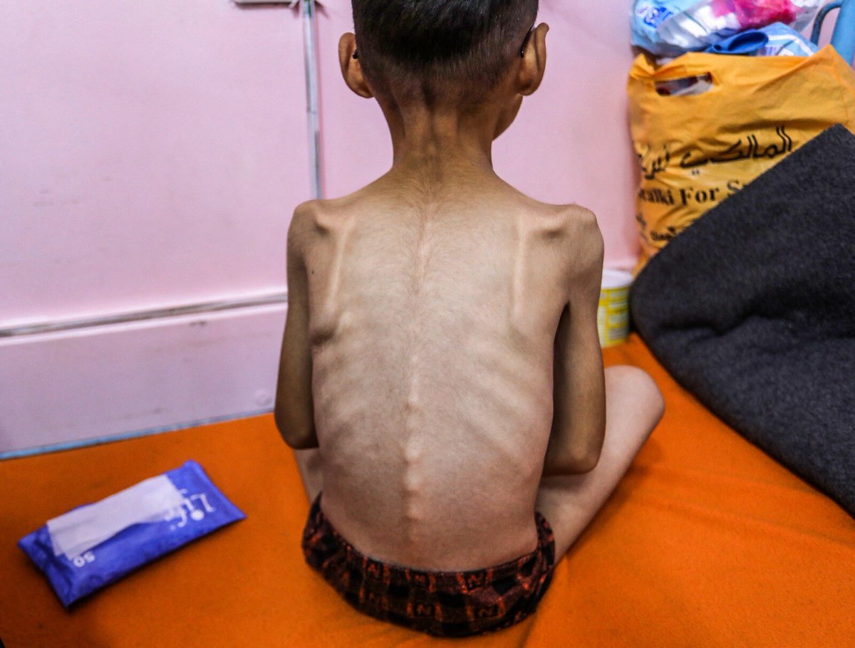Génocide à Gaza : près de 55 000 enfants souffrent de malnutrition aiguë, selon une étude de « The Lancet » 

➡️ l.humanite.fr/Sw7